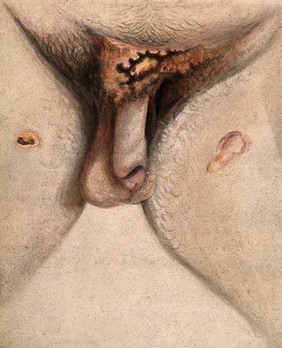 Severely diseased genitals, groin and thighs of a man, showing symptoms of perforating phagedena. Watercolour by C. D'Alton, 18--.