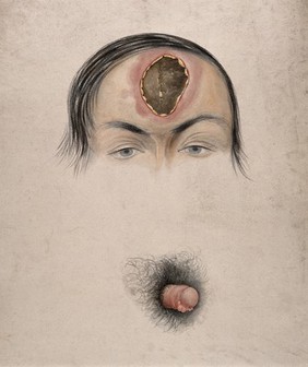 An open wound on the forehead of a man, with a detail below showing a diseased penis (?) Watercolour by C. D'Alton, 1861(?).