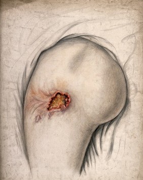 An infected open wound on the outer thigh of a man suffering from creeping or serpiginous phagedena. Watercolour by C. D'Alton, 1858.