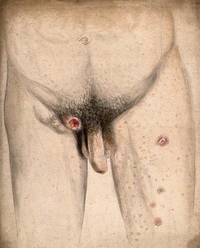 Diseased tissue and swellings in the groin area and thighs of a man. Watercolour by C. D'Alton, 1858.