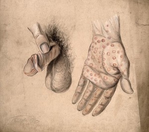 view Diseased areas of tissue on the penis and the palm of the hand of a man: two figures. Watercolour by C. D'Alton, 1857.