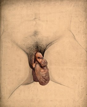 Female genitalia showing symptoms of a prolapsed uterus. Watercolour by C. D'Alton, 18--.