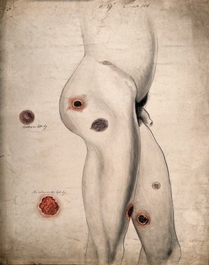 view Ulcers and diseased areas of tissue on the legs and buttocks of a man, with two details showing a cicatrix and an ulcer on the left leg. Watercolour by C. D'Alton, 18--.