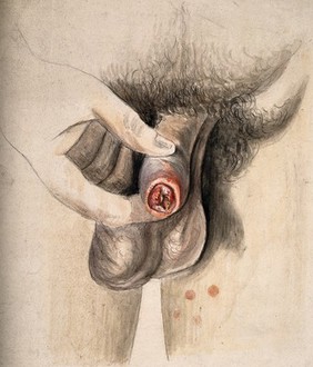 Diseased tissue on the penis and thigh of a man. Watercolour by C. D'Alton, 18--.