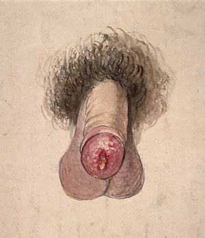 view A diseased penis. Watercolour by C. D'Alton, 1859.