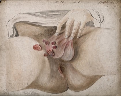 Diseased areas of tissue on the scrotum, rectum and groin of a man. Watercolour by C. D'Alton, ca. 1847.