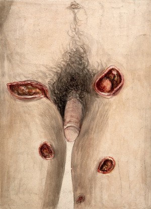 view Areas of severely diseased tissue on the thighs and groin of a man showing symptoms of perforating phagedena. Watercolour with chalk, by C. D'Alton, 18--.