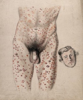 A rash of sores covering the face, legs, torso and genitals of a man: two figures, one showing the body, the other the man's face. Watercolour by C. D'Alton, ca. 18--.