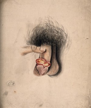 view A diseased penis, showing symptoms of inflammatory or moist gangrene. Watercolour by C. D'Alton, 18--.