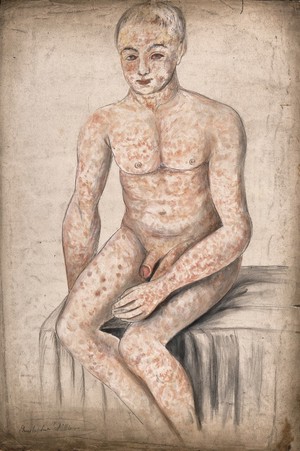 view A seated man suffering from a mottled rash of sores, which covers his entire body and face. Watercolour by C. D'Alton, 1858.