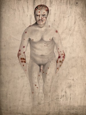 view A seated man suffering from abcesses (?) and diseased areas of skin on his face, head, arms, legs and torso. Watercolour by C. D'Alton, 1867.