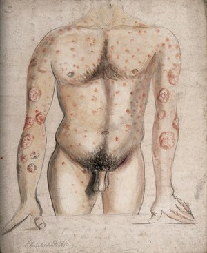 view The torso and arms of a man suffering from abcesses (?) and diseased areas of skin. Watercolour by C. D'Alton, ca. 1856.