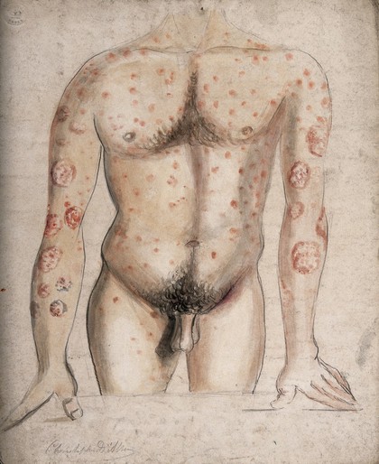 The torso and arms of a man suffering from abcesses (?) and diseased areas of skin. Watercolour by C. D'Alton, ca. 1856.