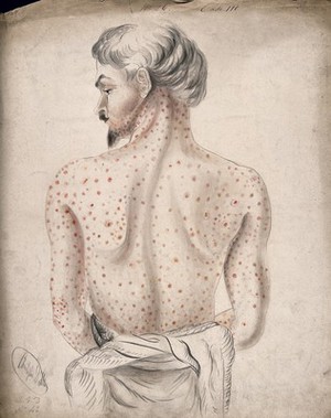 view The back of a man suffering from a rash of sores. Watercolour by C. D'Alton, 1856.