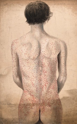 view The back, arms and buttocks of a man suffering from a rash of sores. Watercolour by C. D'Alton, 1858.