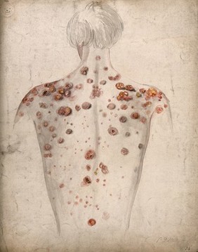 The back and shoulders of a man suffering from diseased skin and abcesses (?). Watercolour by C. D'Alton, 1857.