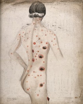 The back, neck, arms and legs of a man suffering from diseased skin and abcesses (?). Watercolour by C. D'Alton, 1857.