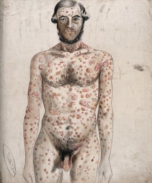 view Sores and abcesses (?) covering the face and body of a man. Watercolour by C. D'Alton, ca. 1853.