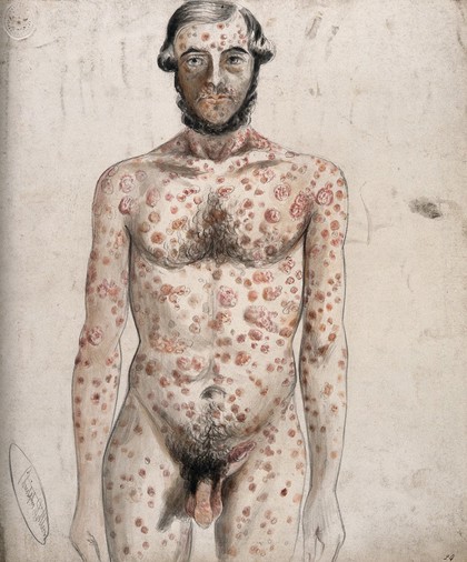 Sores and abcesses (?) covering the face and body of a man. Watercolour by C. D'Alton, ca. 1853.