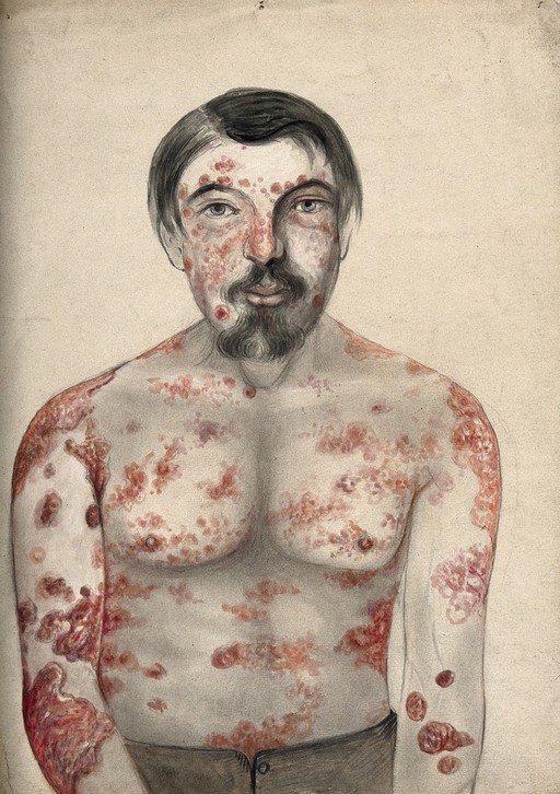 Psoriasis and syphilis; lesions on face and body, 1866