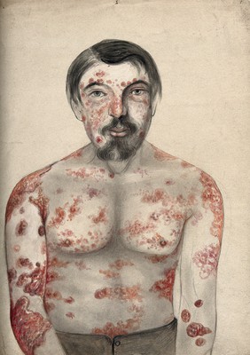 Diseased tissue on the face, shoulders arms and torso of a man suffering from psoriasis and possibly syphilis. Watercolour by C. D'Alton, 1866.