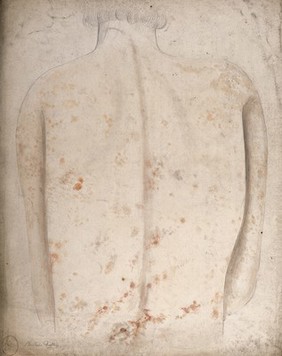 The back of a man suffering with lesions or sores. Watercolour by C. D'Alton, 1857.