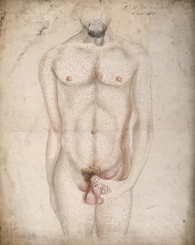 A man suffering from diseased genitals, with a swelling in the groin area and a rash of sores covering his entire body. Watercolour by C. D'Alton, 1856.