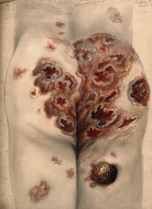 view Severely diseased tissue on the buttocks and thighs of a man. Watercolour by C. D'Alton, 1867.