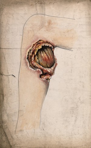 view Severely diseased area of tissue on the calf of a woman's leg. Watercolour by C. D'Alton, 1858.