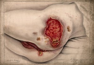 view Severely diseased areas of tissue on the buttocks and genitals of a woman. Watercolour by C. D'Alton, 1868.