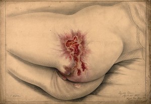 view Diseased areas of tissue on the buttocks and genitals of a woman. Watercolour by C. D'Alton, 1869.