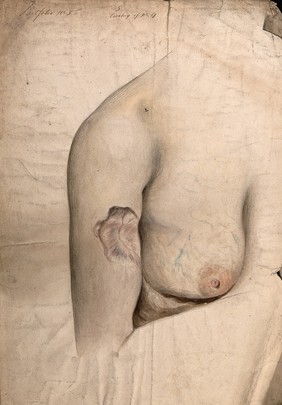 Area of scar tissue on the upper arm of a woman, with the right breast also shown. Watercolour by C. D'Alton, 1859.