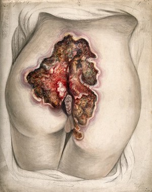 view Severely diseased tissue on the buttocks of a woman, showing symptoms of creeping or serpiginous phagedena. Watercolour by C. D'Alton, 1857.