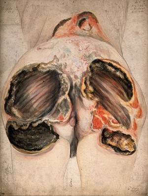 view Severely diseased tissue on the buttocks of a dead woman, showing symptoms of creeping or serpiginous phagedena. Watercolour by C. D'Alton, ca. 1857.