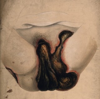 Severely diseased genitals and thighs of a woman. Watercolour by C. D'Alton, 1864.