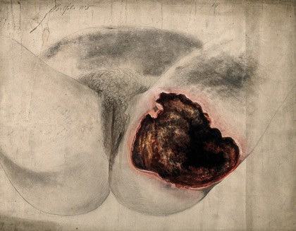 Severely diseased tissue on the thigh and buttock of a woman. Watercolour by C. D'Alton, 1861.