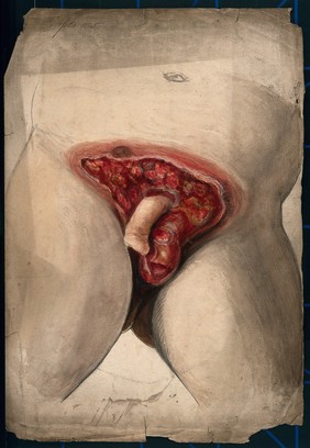 Severely diseased genitals of a man. Watercolour by C. D'Alton, ca. 1860.