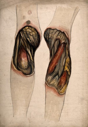 view Severely diseased tissue and muscles on the arms (?) of a dead woman. Watercolour by C. D'Alton, 1858.