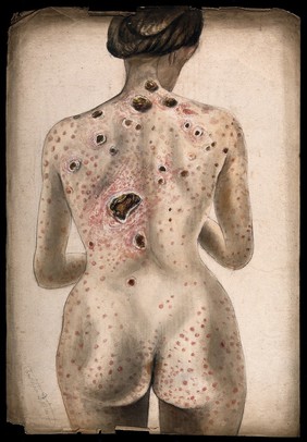 The back, buttocks and arms of a woman, displaying areas of diseased tissue and a rash of sores. Watercolour by C. D'Alton, 1840/1870?.