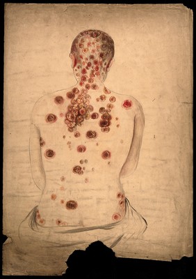 The back, neck and head of a woman, displaying areas of diseased tissue and abcesses. Watercolour by C. D'Alton, 1859.