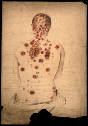 view The back, neck and head of a woman, displaying areas of diseased tissue and abcesses. Watercolour by C. D'Alton, 1859.