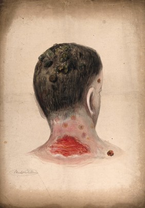 The back of the neck and head of a woman, displaying an area of severely diseased tissue on the neck, with abcesses on the scalp. Watercolour by C. D'Alton, 1858.