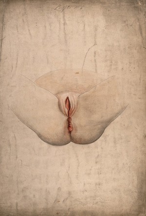 view Diseased tissue on the genitals and anus of an eight year old girl. Watercolour by C. D'Alton, 18--.