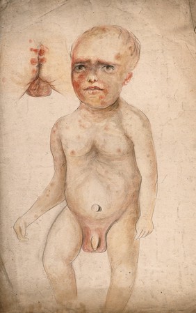 A four month old baby boy with diseased skin on his face and body, with a detail showing sores around the anus and genitals. Watercolour by C. D'Alton, 1858.