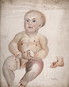 A three month old baby boy with diseased skin and sores on his face and body, with a detail showing the right foot. Watercolour by C. D'Alton, 18--.