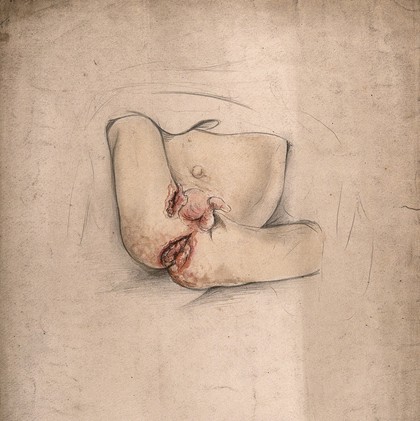 An eleven month old baby boy with severely diseased tissue around the anus and groin areas. Watercolour by C. D'Alton, 1859.