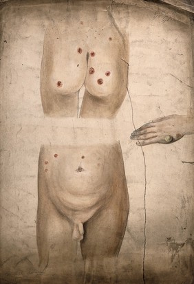 Sores and abcesses (?) on the buttocks and abdomen of a boy suffering from syphilis, with a detail showing a large boil or abcess on the boy's hand. Watercolour by C. D'Alton, 18--.