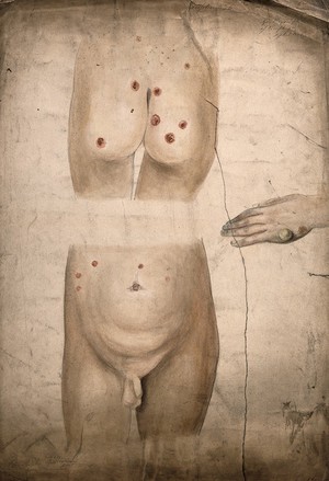 view Sores and abcesses (?) on the buttocks and abdomen of a boy suffering from syphilis, with a detail showing a large boil or abcess on the boy's hand. Watercolour by C. D'Alton, 18--.