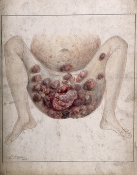 Severely diseased tissue and abcesses on the buttocks, genital area and thighs of a two year old boy. Watercolour by C. D'Alton, 1876.