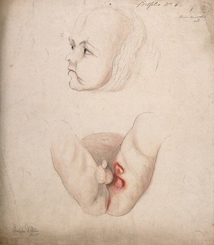Diseased tissue around the anus and genital area of a nine month old baby boy, with a detail showing the baby's face. Watercolour by C. D'Alton, 1857.